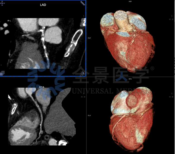 控糖不力，并发症悄然而至——影像学评估心、脑、肾、足风险