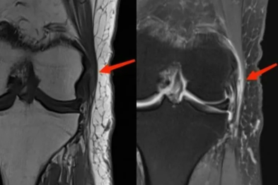 【高尚病例】髂胫束综合征 2 例