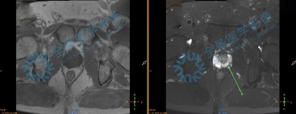 40 岁前列腺已萎缩？前列腺问题并非老年男士的「专利」