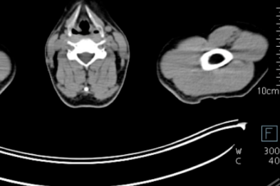 淋巴瘤治疗显成效！PET/CT 见证病灶「大撤退」