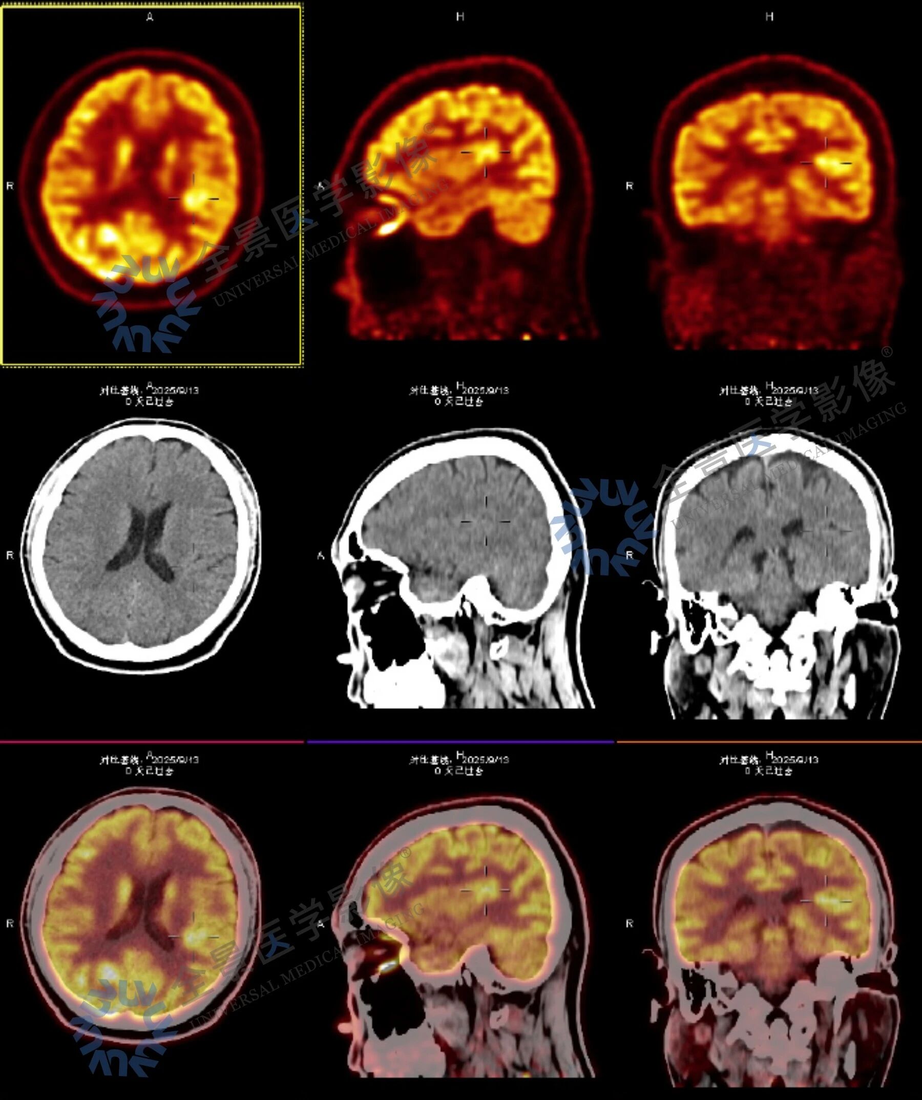 持续 6 年的「眩晕症」，遍查无果后终于找到了答案