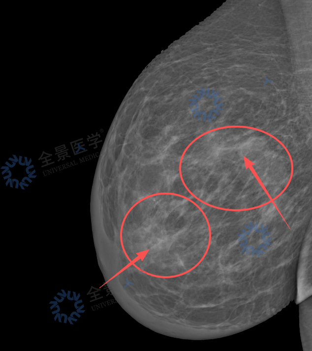 从「结节 4A 类」到「炎性乳腺癌」:一次深度筛查,改写她的生命轨迹