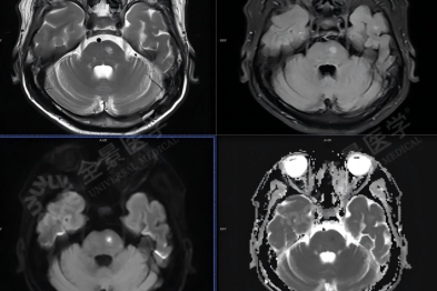 体检必看：比查肿瘤更易忽视的脑血管风险！