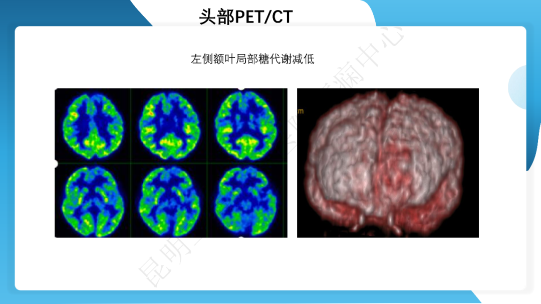 《「痫停」信步》癫痫治疗病例荟萃第四十二期---手术治疗孤立性皮层发育不良为表现的结节性硬化一例