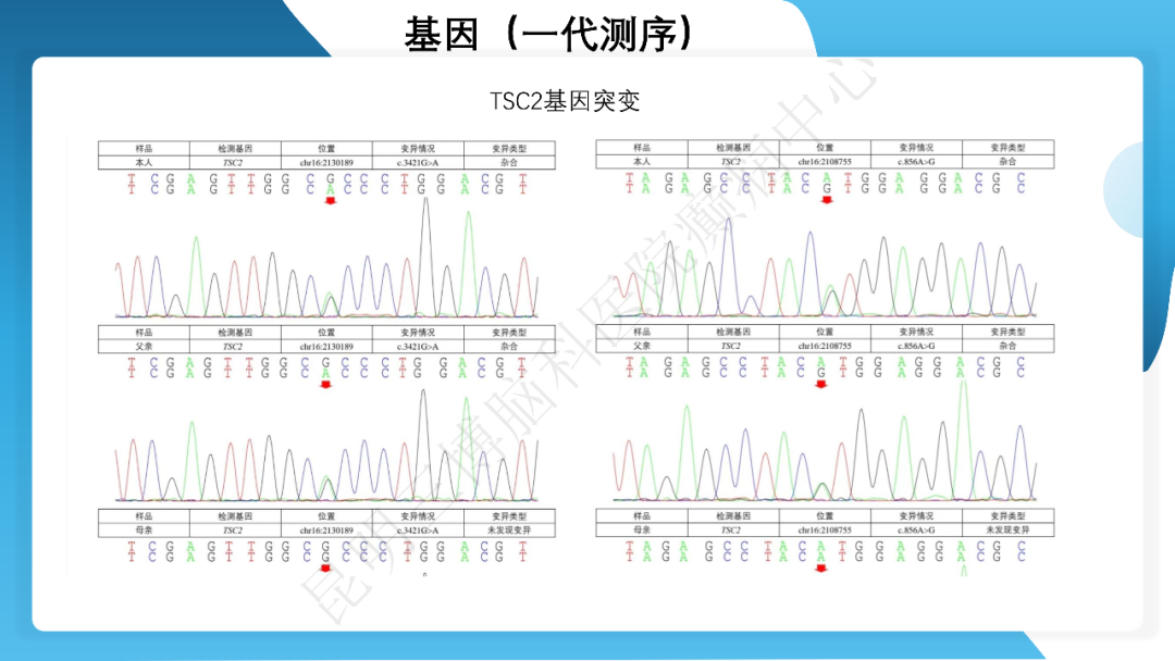 《「痫停」信步》癫痫治疗病例荟萃第四十二期---手术治疗孤立性皮层发育不良为表现的结节性硬化一例