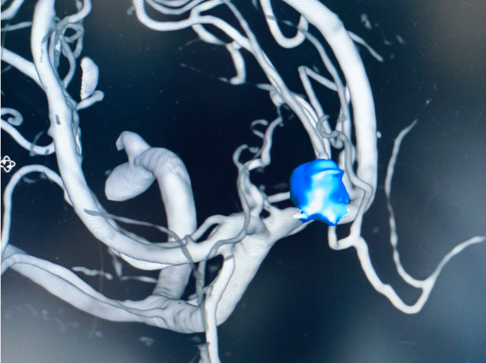 熬夜引爆大脑 「炸弹」大出血,医生紧急提醒:作息乱的人赶紧看