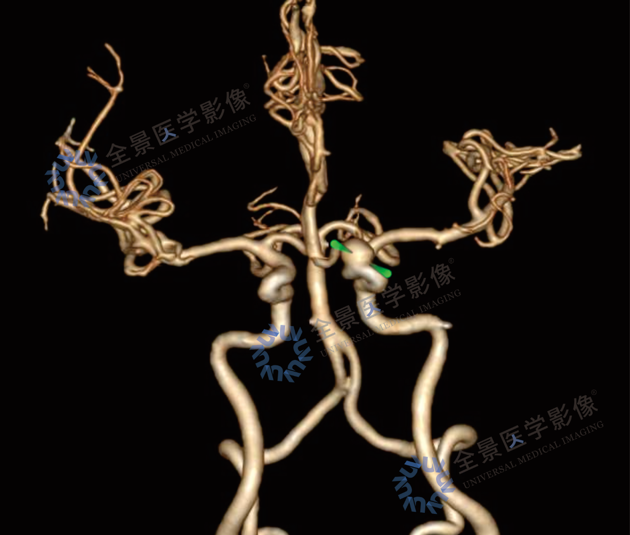 血脂血糖双高下的隐蔽风险：一次深度健检拉响「颅内炸弹」警报