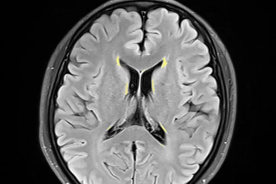 头痛头晕十余年，所谓「小病」也很折磨人！