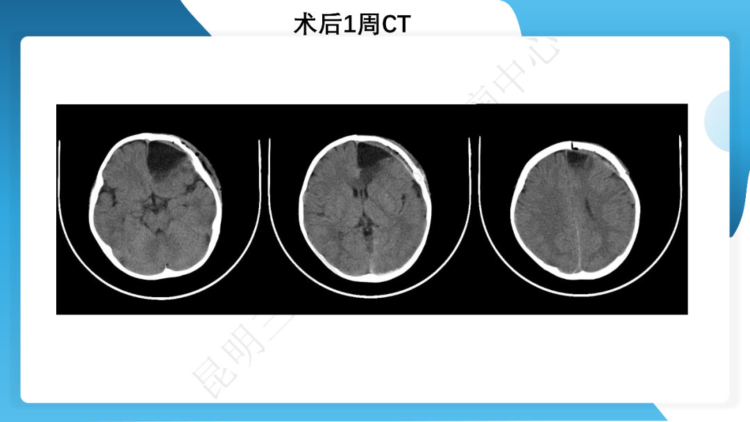 《「痫停」信步》癫痫治疗病例荟萃第四十二期---手术治疗孤立性皮层发育不良为表现的结节性硬化一例