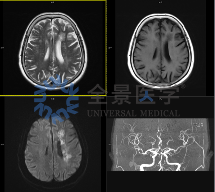 控糖不力，并发症悄然而至——影像学评估心、脑、肾、足风险