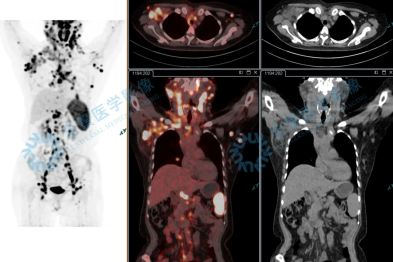 「牵一发而动全身」—以为是肺的事，PET/CT 揭秘—全身淋巴瘤