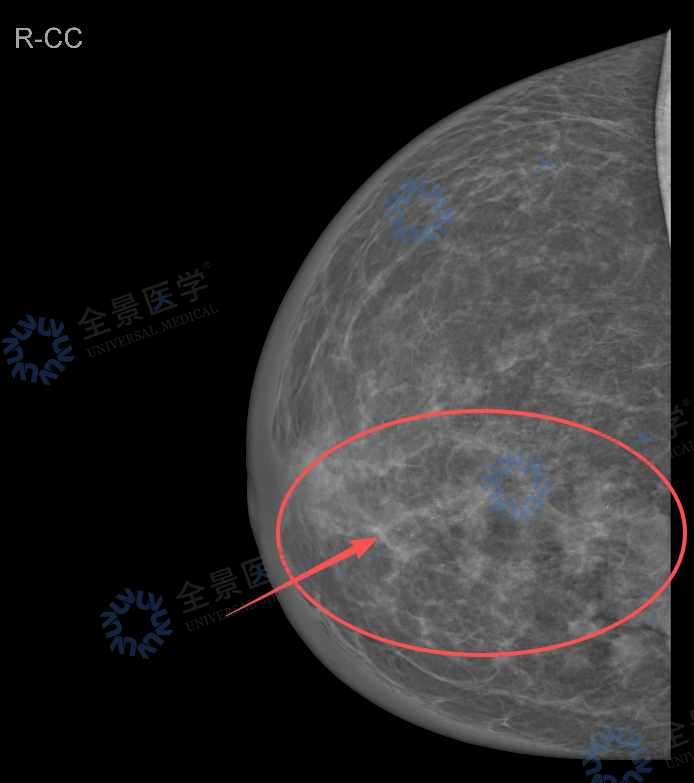 从「结节 4A 类」到「炎性乳腺癌」:一次深度筛查,改写她的生命轨迹