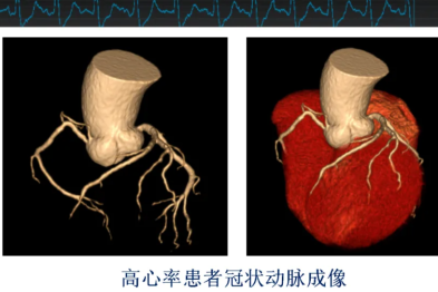 【融和有绝活】医学影像科硬核技术：Revolution CT 解锁精准诊疗新「镜」界