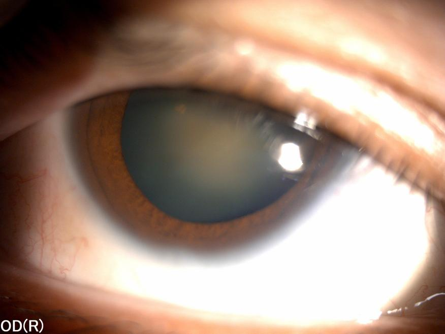 武汉普瑞眼科阮丽娟用飞秒白内障手术植入三焦点晶体解决男子眼疾