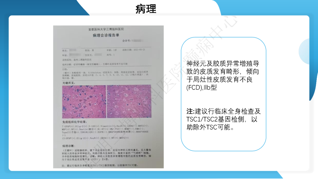 《「痫停」信步》癫痫治疗病例荟萃第四十二期---手术治疗孤立性皮层发育不良为表现的结节性硬化一例