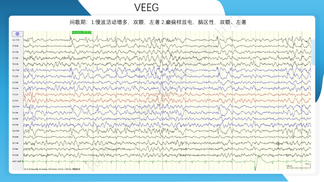 《「痫停」信步》癫痫治疗病例荟萃第四十二期---手术治疗孤立性皮层发育不良为表现的结节性硬化一例