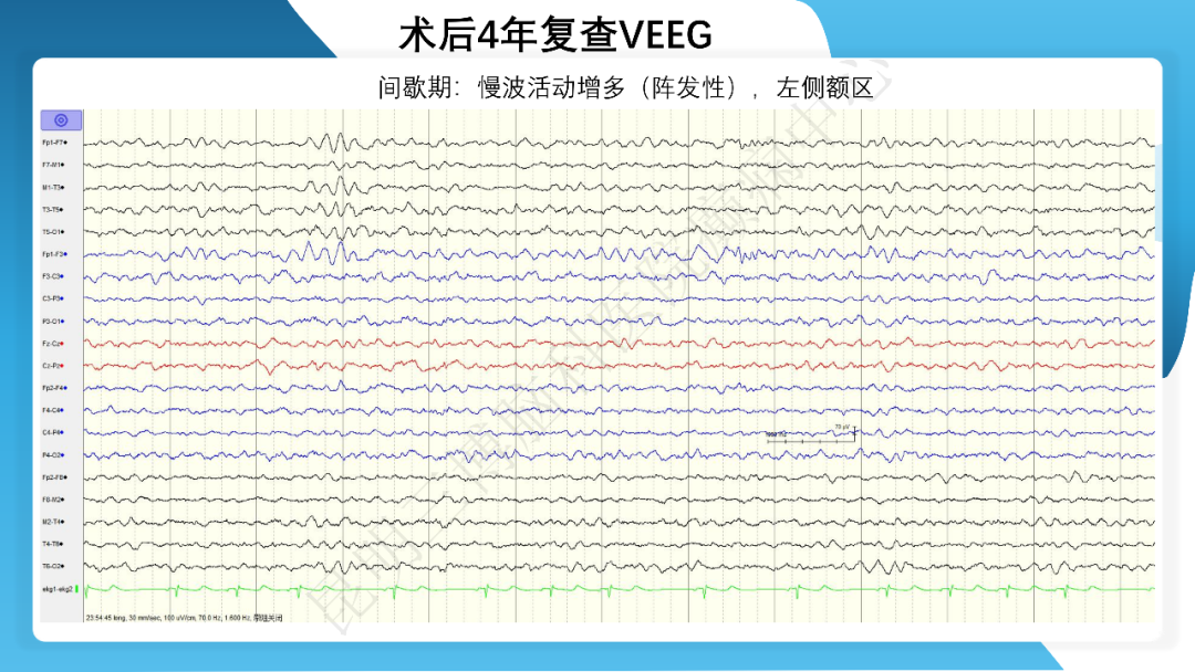 《「痫停」信步》癫痫治疗病例荟萃第四十二期---手术治疗孤立性皮层发育不良为表现的结节性硬化一例