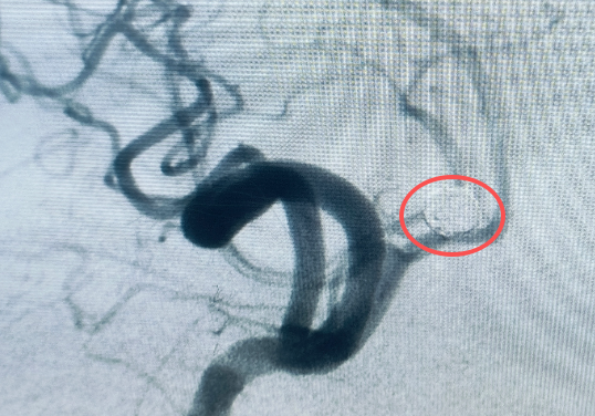 熬夜引爆大脑 「炸弹」大出血,医生紧急提醒:作息乱的人赶紧看