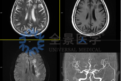 控糖不力，并发症悄然而至——影像学评估心、脑、肾、足风险