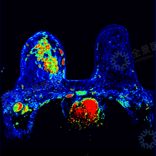 从「结节 4A 类」到「炎性乳腺癌」:一次深度筛查,改写她的生命轨迹