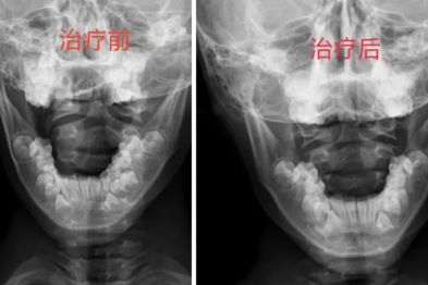 怪了！8 岁娃头晕到没法上学，病因成谜！竟是它在「捣乱」……