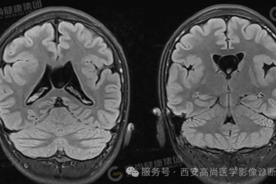 【高尚病例】脑裂畸形 MR