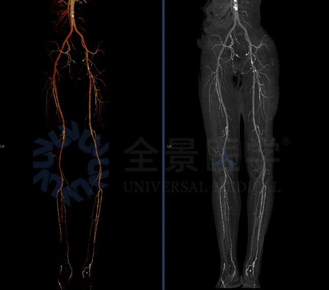 控糖不力，并发症悄然而至——影像学评估心、脑、肾、足风险