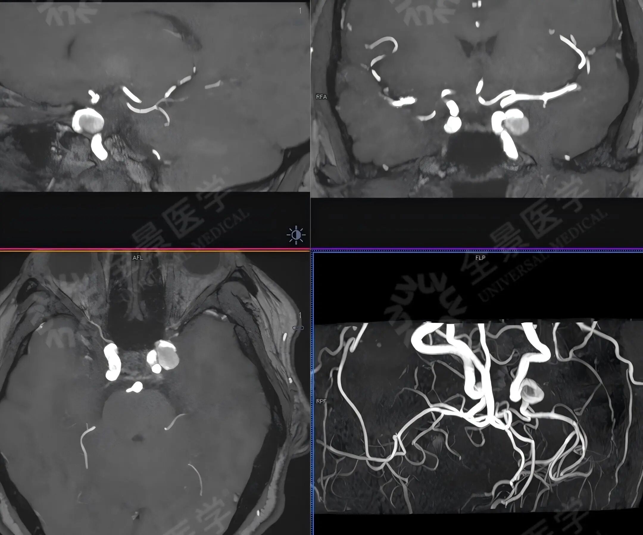 体检必看：比查肿瘤更易忽视的脑血管风险！