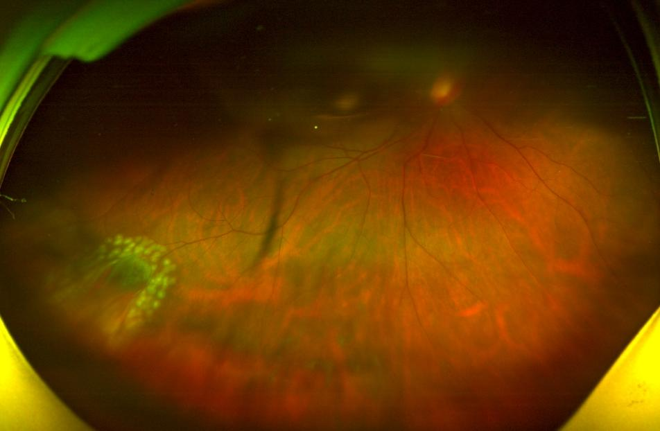 看东西有黑影漂浮是什么原因？武汉普瑞眼科许泽骏介绍视网膜脱离