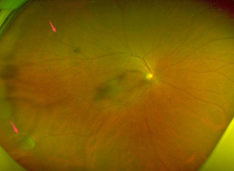 看东西有黑影漂浮是什么原因？武汉普瑞眼科许泽骏介绍视网膜脱离