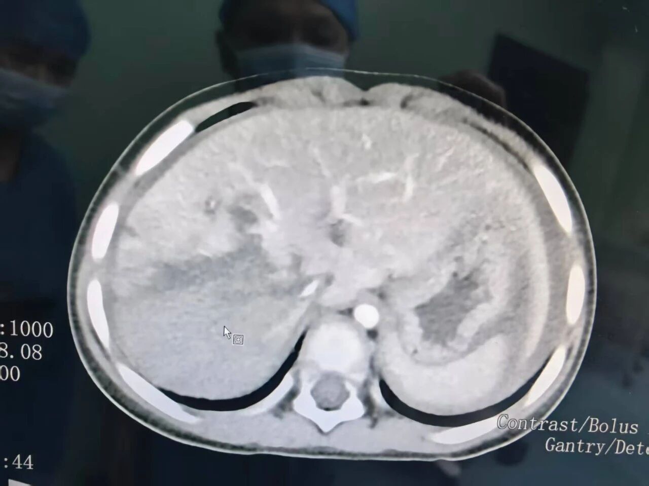 援疆动态丨 2 岁车祸患儿肝脏损伤，广东援疆专家紧急手术挽回生命