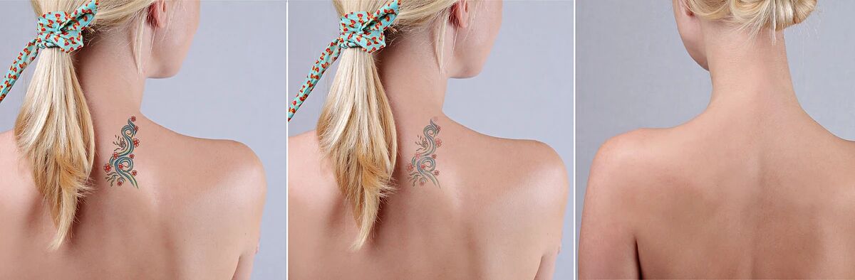 激光洗纹身：能否洗干净？会不会留疤？答案都在这里