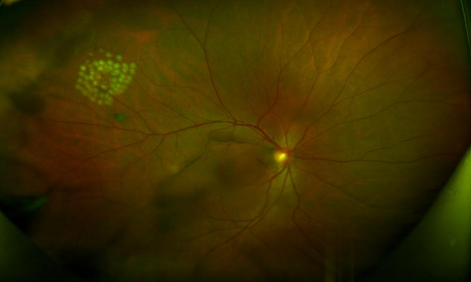 看东西有黑影漂浮是什么原因？武汉普瑞眼科许泽骏介绍视网膜脱离