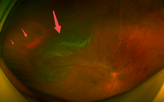 看东西有黑影漂浮是什么原因？武汉普瑞眼科许泽骏介绍视网膜脱离