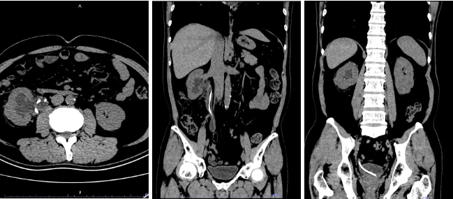 支架「超期服役」8 个月被结石「五花大绑」，泌尿外科精细「拆弹」成功取出