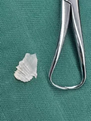 喝醋、吞饭、抠喉咙？3 厘米鱼刺的取出实录，叫停所有危险动作