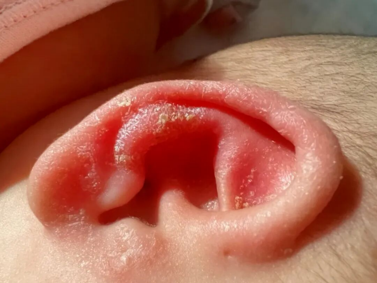 宝宝总挠耳朵?不是卖萌,可能是这几种健康信号!