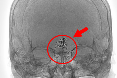 「难上+难」的复发动脉瘤手术