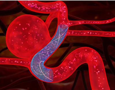 「难上+难」的复发动脉瘤手术