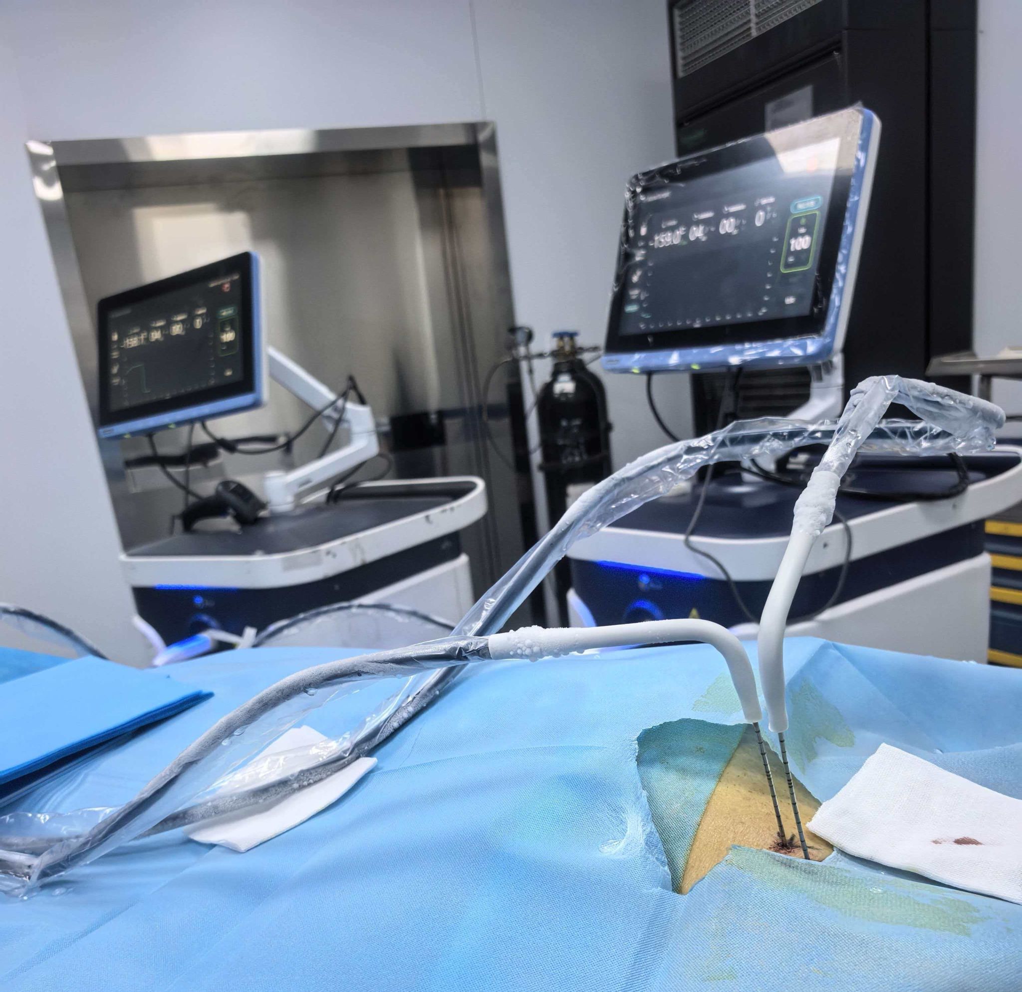 微创冷冻消融术助力多例肺肿瘤患者快速康复