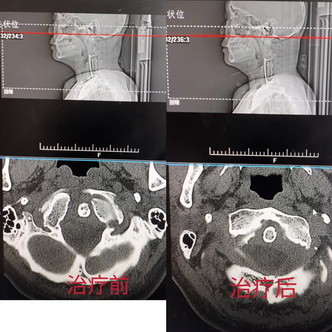 别只怪久坐！从搬重物到扛压力，你的身体可能早就「歪」了
