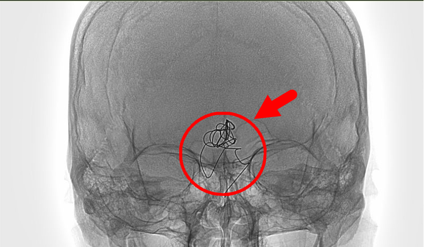 「难上+难」的复发动脉瘤手术
