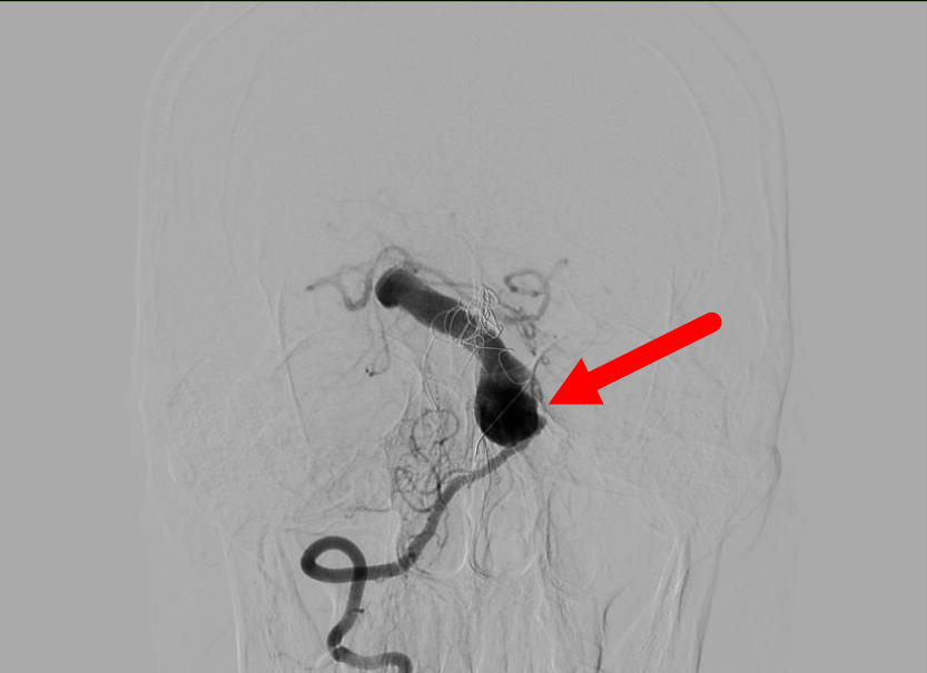 「难上+难」的复发动脉瘤手术