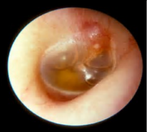 宝宝总挠耳朵?不是卖萌,可能是这几种健康信号!