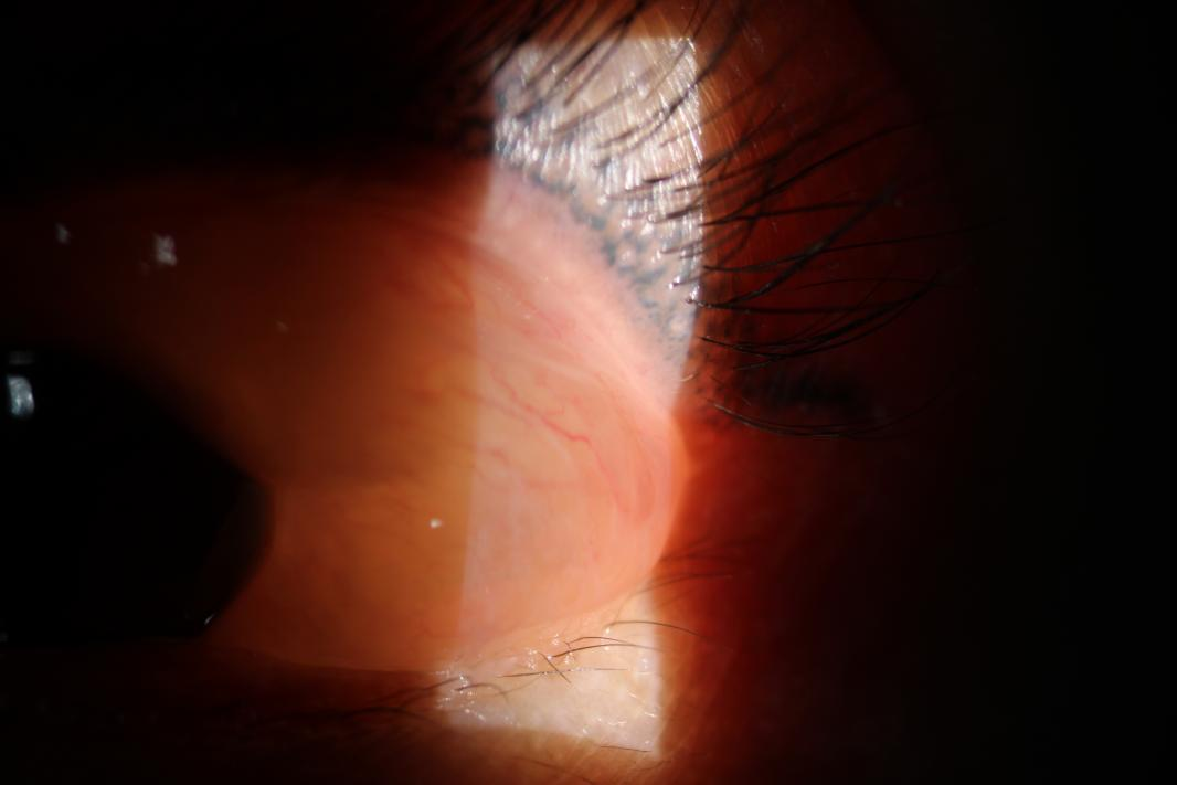 铲屎官被猫咪唾液「袭击」，眼睛秒变「水气球」