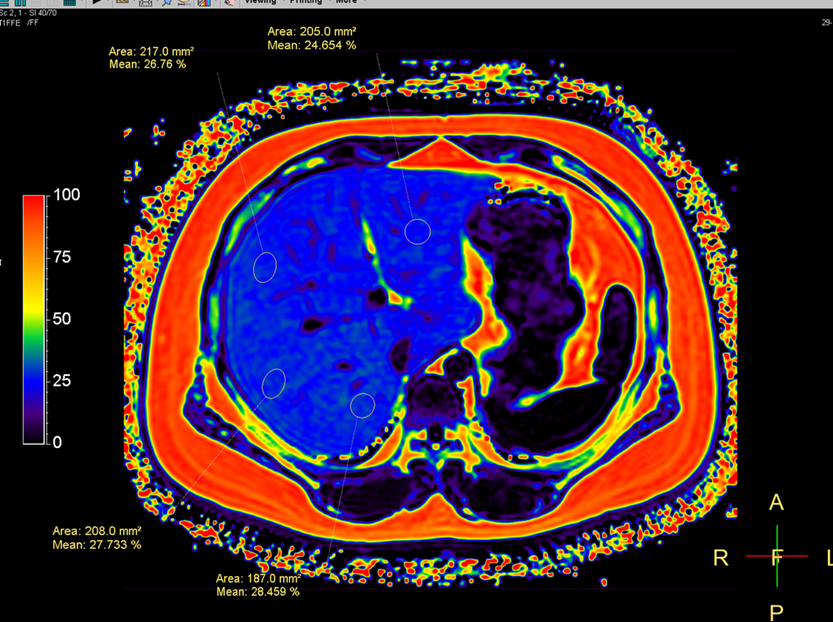 国家不允许你发胖！磁共振肝脏脂肪定量分析检查正当时