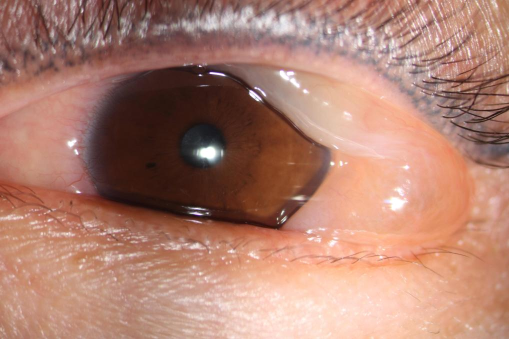 铲屎官被猫咪唾液「袭击」，眼睛秒变「水气球」