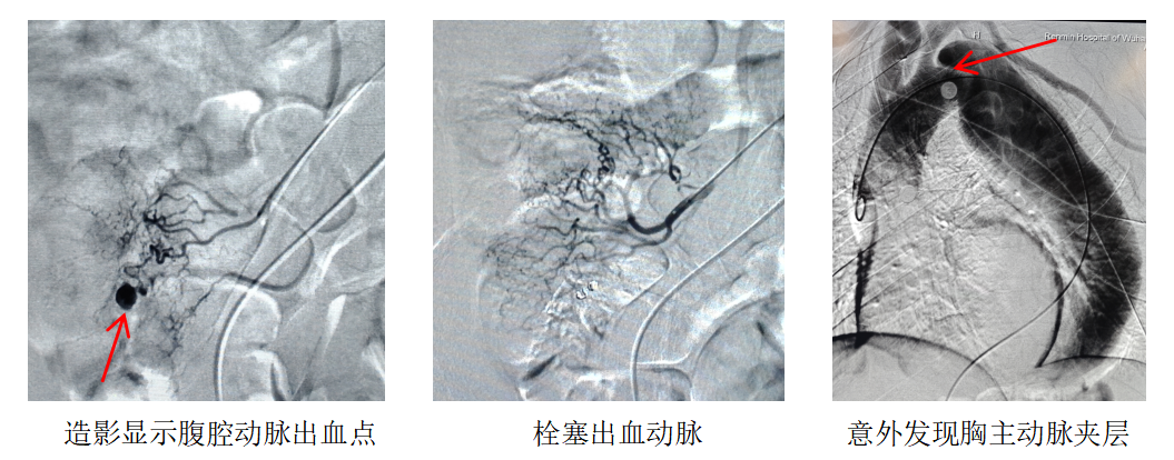 武汉大学人民医院成功救治「消化道大出血+主动脉夹层」双重致命急症患者