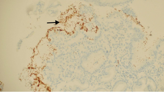 确定肿瘤的组织来源、辅助病理诊断、指导靶向治疗、标记细菌病毒……燕达医院病理科带大家认识免疫组化