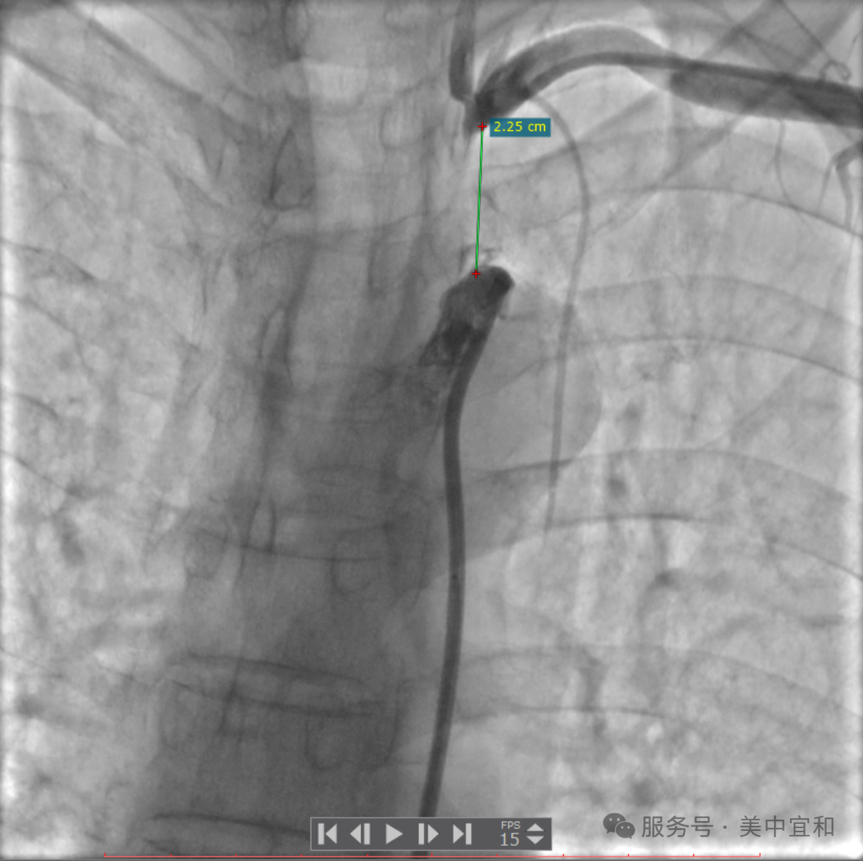 头晕、手臂无力，两臂血压差值大于 30 mmHg，警惕锁骨下动脉在「盗血」